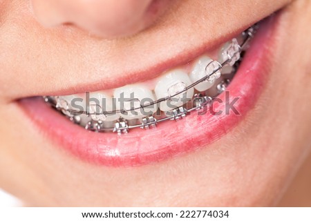 Mouth with braces and beautiful teeth