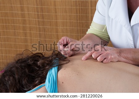 Doctor putting acupuncture needles on woman\'s shoulder,close-up