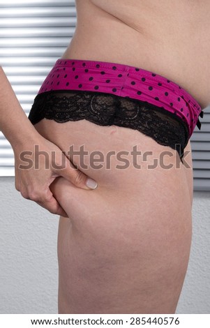 Woman showing Cellulite - bad skin condition