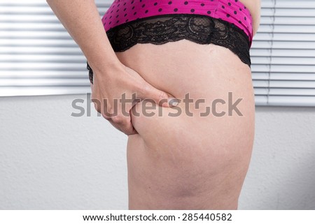 Woman showing Cellulite - bad skin condition