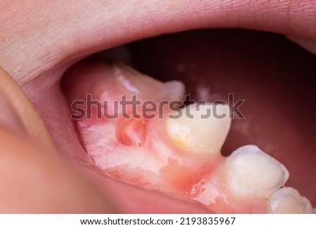 A bump is a tumor on the tooth gum in a child. Periodontitis in children due to a tooth with pulpitis. Imagine de stoc © 
