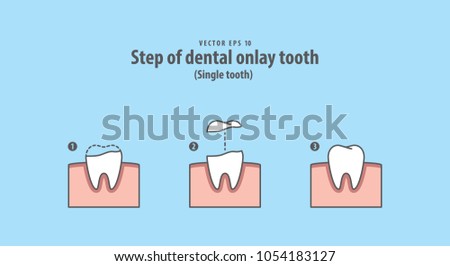 Step of dental onlay tooth (Single tooth) illustration vector on blue background. Dental concept.
