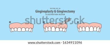 Gingivoplasty & Gingivectomy step (upper) electrosurgery cut gum off illustration vector on blue background. Dental concept.