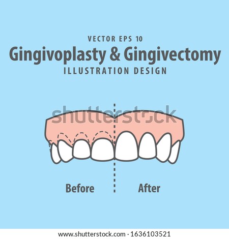 Compare upper teeth Gingivoplasty & Gingivectomy surgery before and after electrosurgery cut gum off illustration vector on blue background. Dental concept. 