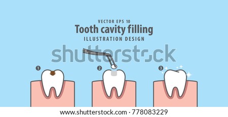 Step of tooth cavity filling illustration vector on blue background. Dental concept.