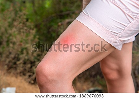 Insect bite on a woman's leg. A woman was bitten by an insect, a large red insect bite mark. outdoors in the forest. concept of protection from insect bites