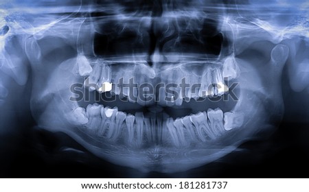 Panoramic dental teeth X-Ray