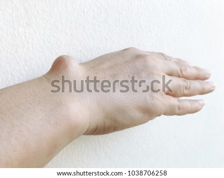 Big ganglion cyst (fluid filled lump associated with a joint, a tumor or swelling on top of a joint or the covering of a tendon) back of wrist on the right hand of woman on white background Foto d'archivio © 