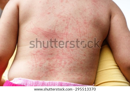 Red spots on baby\'s skin due to Dengue virus (Dengue hemorrhagic fever)