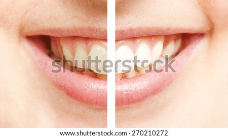 Comparison between white teeth after bleaching and before teeth whitening