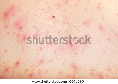 Detail of male skin with checken pox background