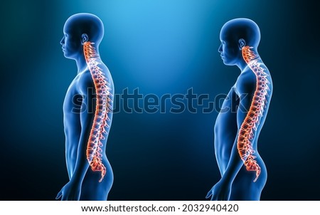Comparison between normal backbone and lordosis curvature of the spine with man model from lateral view 3D rendering illustration. Human anatomy, spinal deformity, backbone pathology, medical concepts Foto d'archivio © 