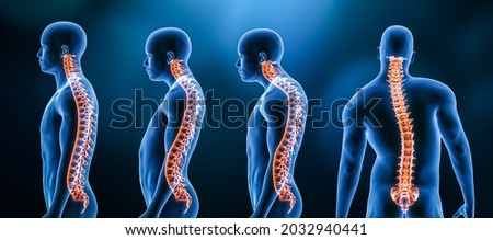 Three main curvatures of the spine disorders or deformities on male body: lordosis, kyphosis and scoliosis 3D rendering illustration. Human anatomy, back injury or disease, medical concepts. Foto d'archivio © 