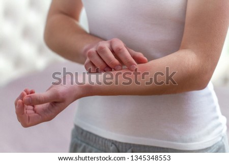 Young woman suffering from itching on her skin and scratching an itchy place. Allergic reaction to insect bites, dermatitis, food, drugs. Health care concept. Allergy rash  Zdjęcia stock © 