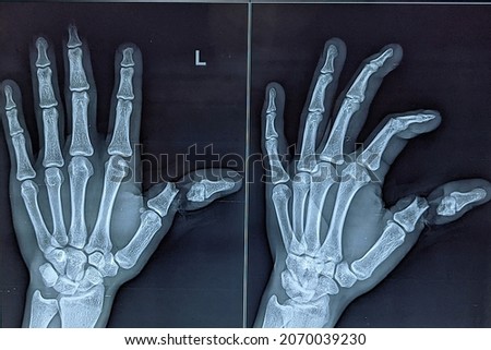 Radiological (X-ray) image of traumatic amputation of left thumb Сток-фото © 