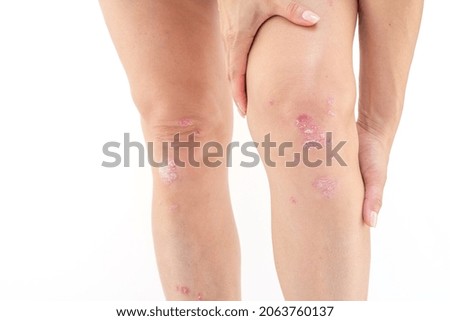 Knee joint effusion ( water on the knee).Acute psoriatic arthritis, arthrosis ,meniscus injury.Excess synovial fluid in and around the left knee joint Photo stock © 
