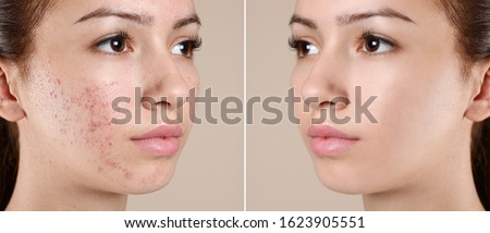 Teenage girl before and after acne treatment on beige background