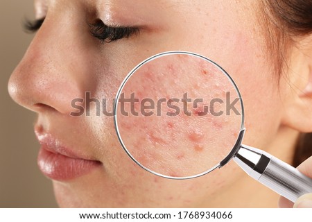 Teenage girl with acne problem visiting dermatologist, closeup. Skin under magnifying glass