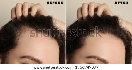 Woman suffering from baldness on beige background, closeup. Collage with photos before and after treatment
