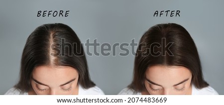 Woman with hair loss problem before and after treatment on grey background, collage. Visiting trichologist Stockfoto © 