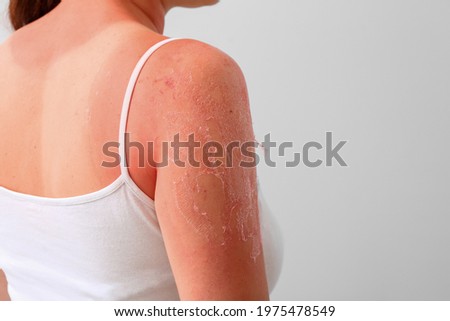 Woman with red sunburned skin against light background, closeup Foto d'archivio © 