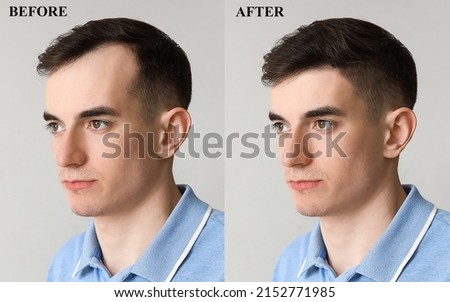 Young man before and after hair loss treatment on light background Stockfoto © 