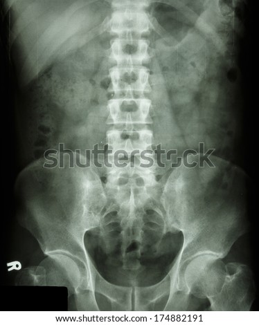 film X-ray L-S spine AP(Antero-posterior) show normal human\'s lumbosacral spine (L-S spine)