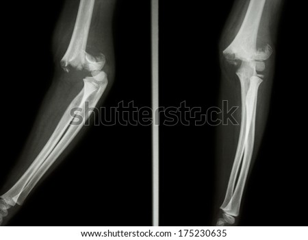 Film X-ray elbow show Supracondylar humerus fracture