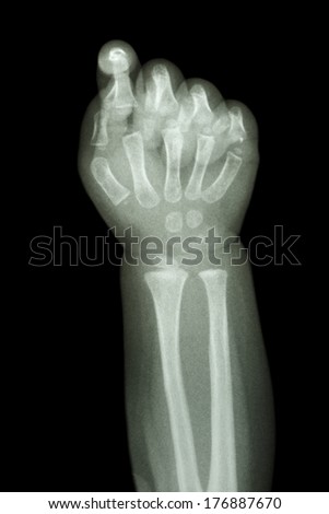 film x-ray infant\'s forearm and hand : show normal infant\'s bone