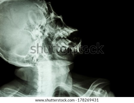 film x-ray skull lateral : show normal human\'s skull