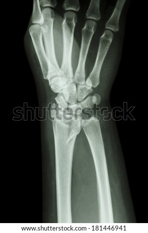 film x-ray wrist show fracture distal radius (forearm\'s bone)