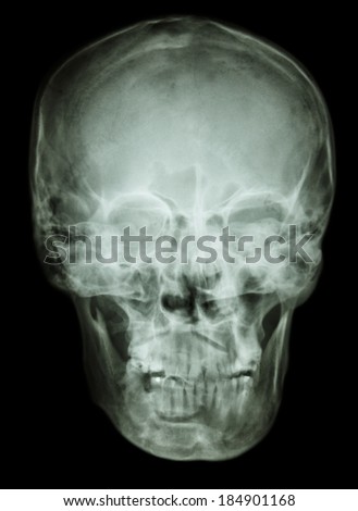 film skull AP(antero-posterior) show normal human skull