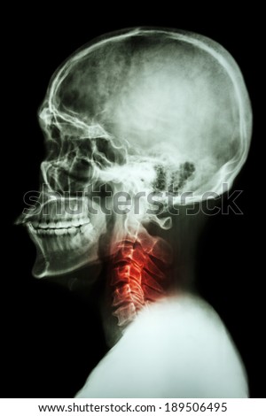 X-ray asian skull and cervical spine and neck pain