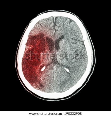 CT brain : show Ischemic stroke (hypodensity at right frontal-parietal lobe)