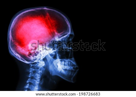 X-ray skull & cervical spine (lateral) with \