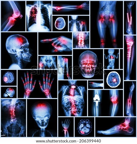 Collection of X-ray multiple part of human,Orthopedic operation and multiple disease (Stroke,Fracture,Gout,Rheumatoid arthritis,Scoliosis,Osteoarthritis knee,Tuberculosis, etc )