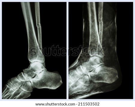 Left image : Fracture shaft of fibula (calf bone)  ,  Right image : It was splinted with plaster cast