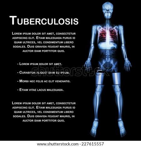 Pulmonary Tuberculosis(TB)(X-ray whole body : head skull neck spine shoulder arm elbow forearm wrist hand finger thorax chest heart lung rib back abdomen pelvis hip thigh knee leg ankle foot heel toe)