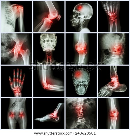 Collection human joint and arthritis and stroke ( skull head neck shoulder chest thorax shoulder arm elbow forearm wrist hand finger palm spine back pelvis thigh knee leg foot ankle toe)