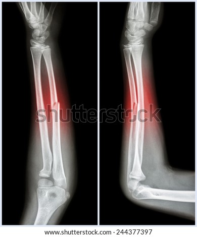 Fracture shaft of ulnar bone ( forearm bone )  :  ( front and side view )