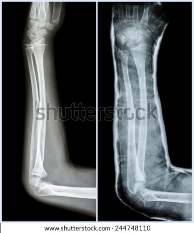 Fracture shaft of ulnar bone ( forearm bone )  : ( Left : pre-treatment  ,  Right : Psot-treatment (splint with cast) )