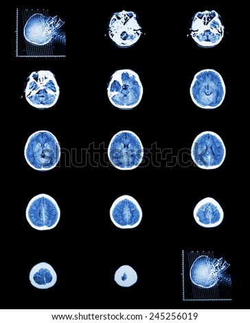 CT scan (computed tomography) of normal brain ( cerebrovascular system )