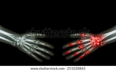 X-ray normal person is shaking hand with Arthritis hand person