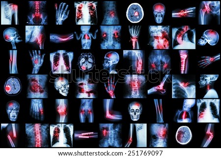 X-ray multiple disease of child and adult ( Stroke , Arthritis , Fracture , Tuberculosis , Brain tumor , Bowel obstruction  , Kidney stone , Spondylosis , Spondylolisthesis , Osteoarthritis knee ,etc)