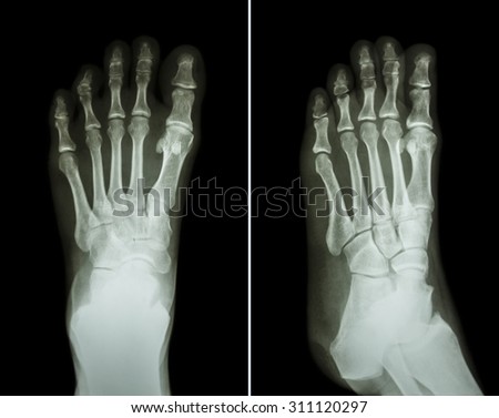 Film x-ray both foot ( 2 position : front view and side view )