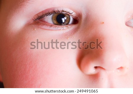 red eyes of a child. Boy with conjunctivitis. Little boy with having spring allergy