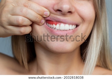 Gum inflammation. Close-up of a young woman showing bleeding gums on a gray background. Dentistry, dental care Foto stock © 