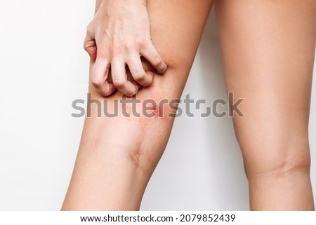 Similar – Image, Stock Photo skin allergies, hips skin women. Closeup of red pustules on a hips, an allergic reaction caused by atopic dermatitis. Selected focus