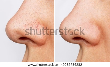 Close-up of woman's nose with blackheads or black dots before and after peeling and cleansing the face isolated on a white background. Acne problem, comedones. Profile. Cosmetology dermatology concept