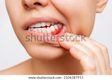 Gum inflammation. Cropped shot of a young woman showing red bleeding gums isolated on a white background. Close up. Dentistry, dental care	 Foto stock © 